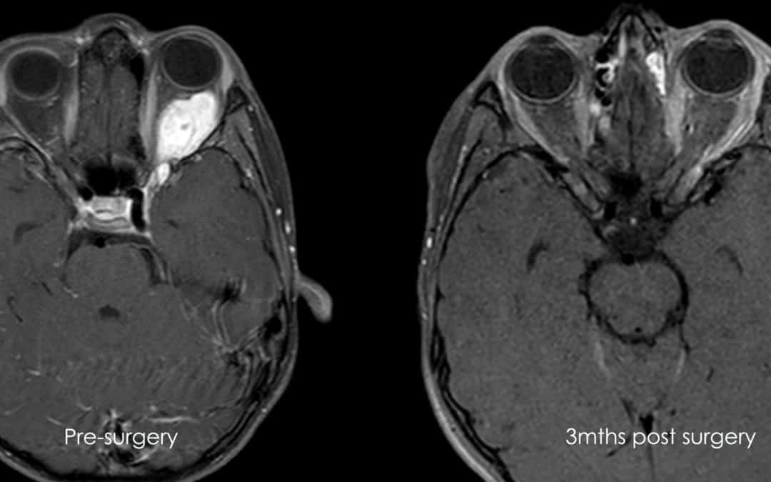 Evolution of endoscopic sinus surgery in orbital tumours