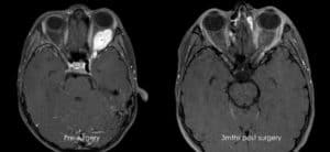 Endoscopic sinus surgery sydney 