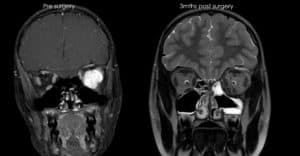 endoscopic sinus nasal surgery sydney