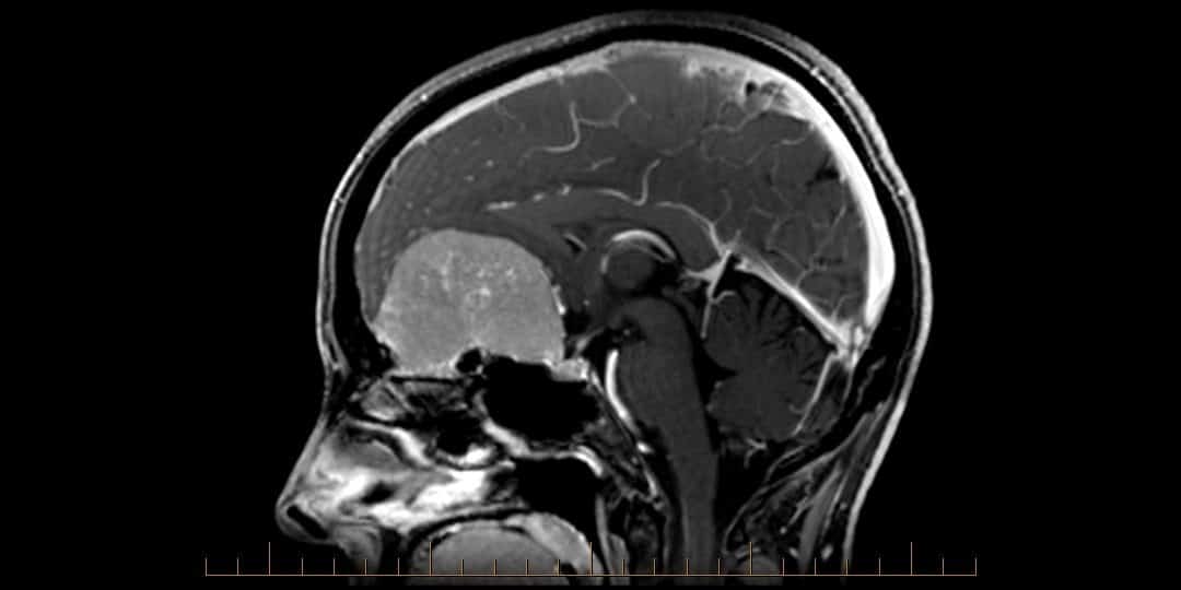 Minimally invasive techniques for skull base and nasal tumour surgery