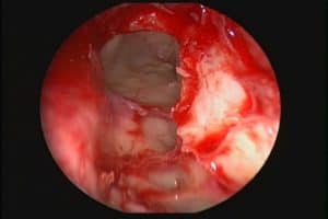 frontal sinus sinusitis sydney harvey