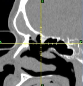 Frontal sinus surgery, function and sinusitis