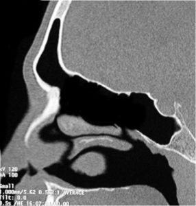 frontal sinus surgery harvey sydney