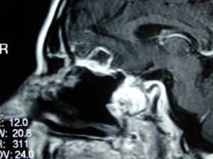 sinus surgery safe sydney