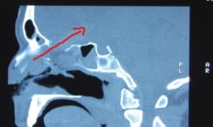 sinus surgery safe sydney
