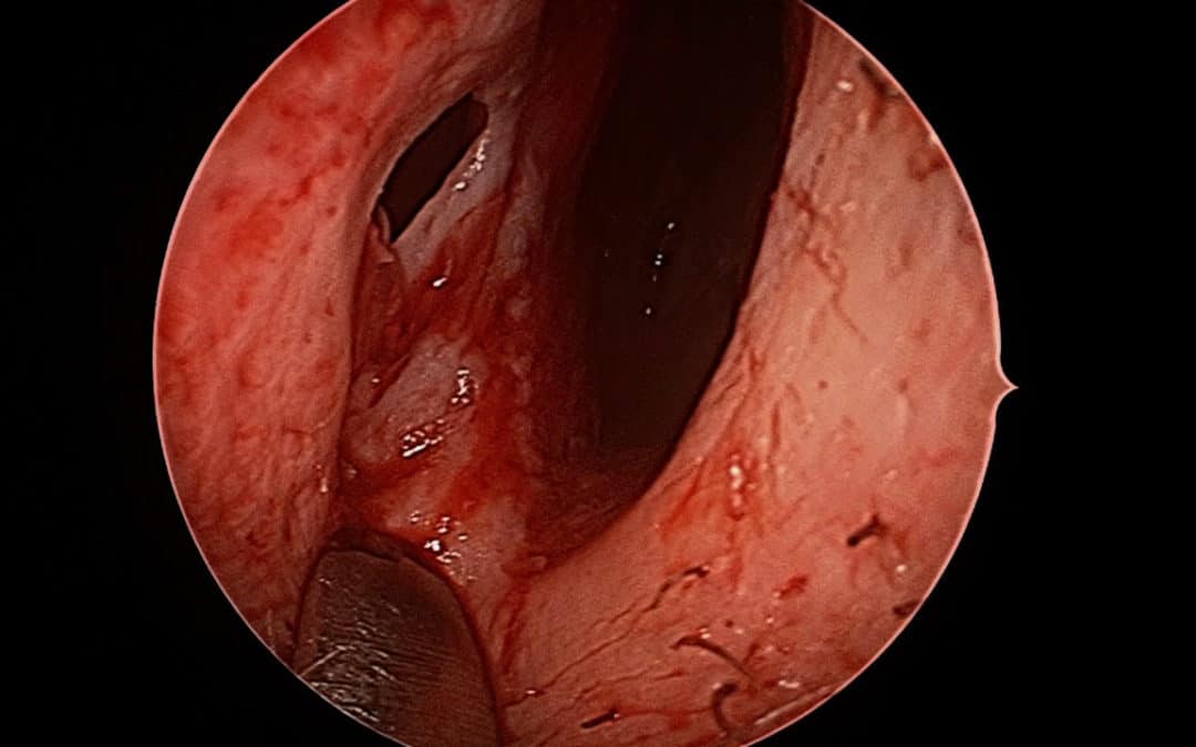 Septal perforation : no longer the avoided surgery