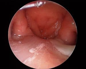 richard harvey sinusitis sydney sinus surgery
