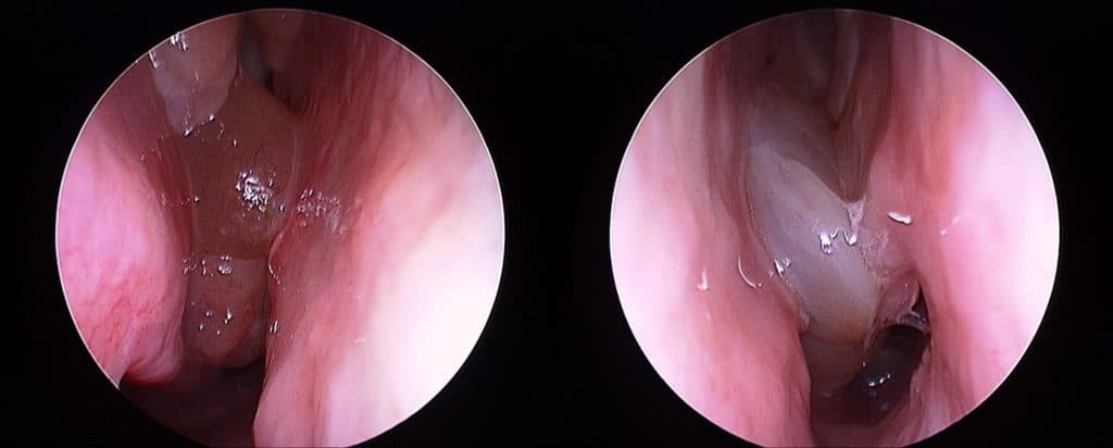 nasal polyps richard harvey sydney