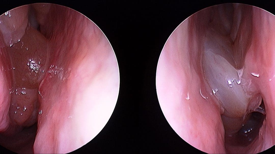 Modern treatment for nasal polyps and sinusitis