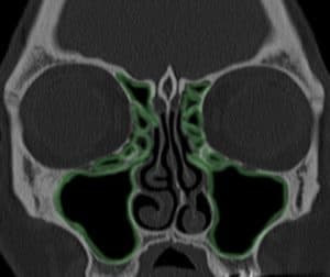 richard harvey sinus surgery sydney