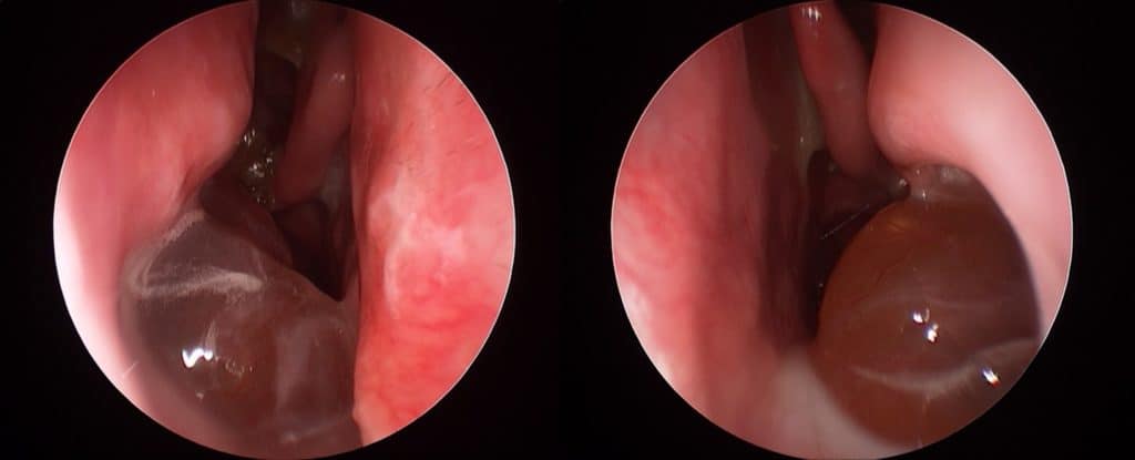non-eosiniophilic polyps and macrolide response richard harvey sydney