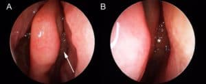 can't smell loss of smell polyps sydney sinus harvey