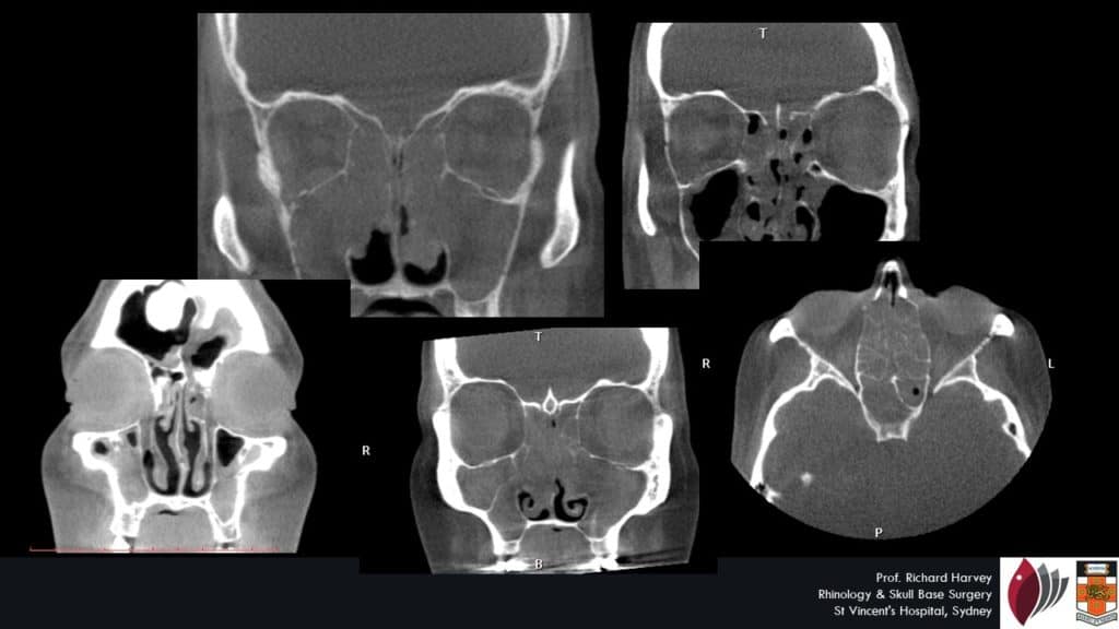 fees costs costs sinus nose surgery sydney