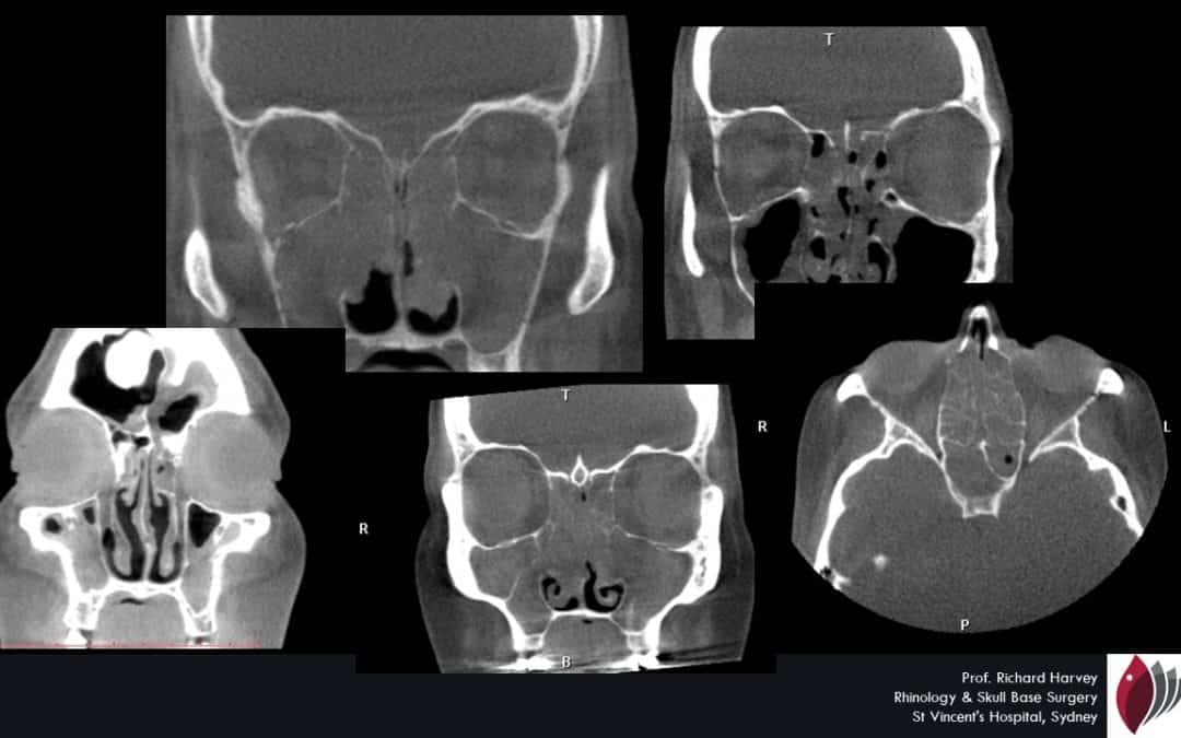 Understanding Inflammatory sinusitis, nasal polyps and chronic sinusitis