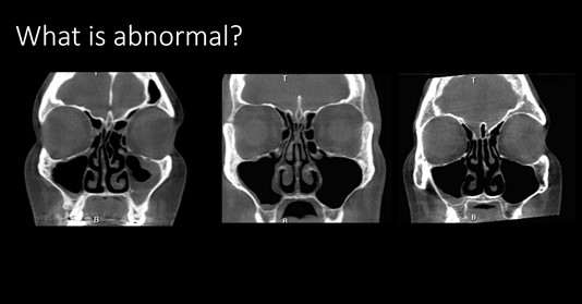 Do I really have sinusitis: matching imaging to “chronic sinus symptoms”?