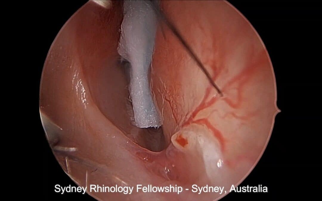 Nose bleeds (epistaxis) and high blood pressure (hypertension)