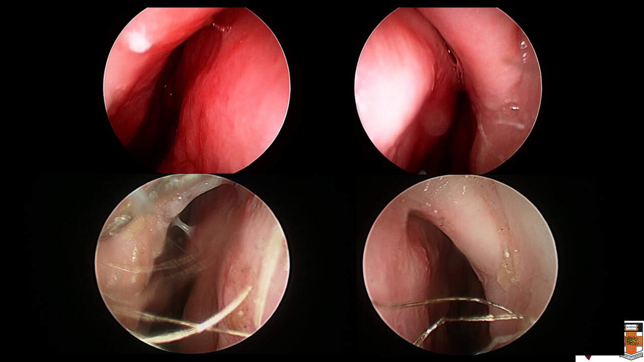 septal surgery septal deviaiton