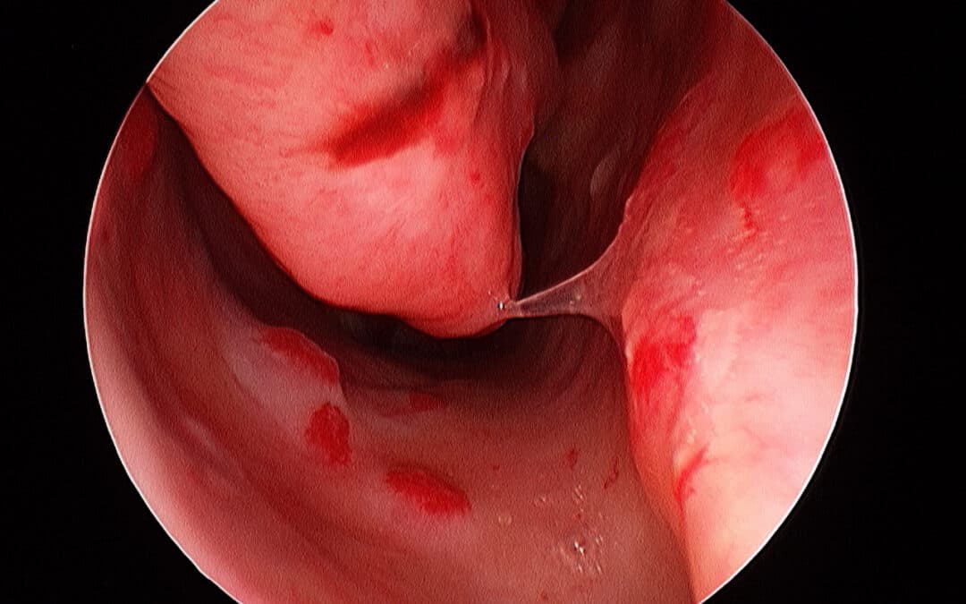 HHT Nosebleed Treatment in Australia: An Algorithm for Refractory Epistaxis