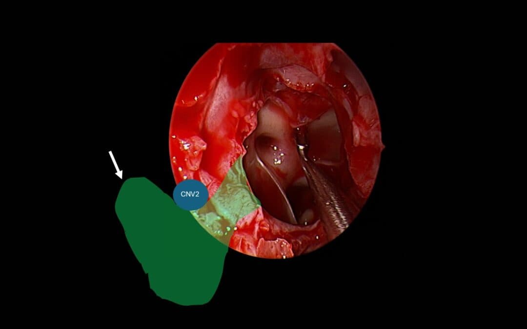 Lateral Sphenoid CSF Leak: Why the “Transpterygoid” Debate Misses the Real Surgical Question