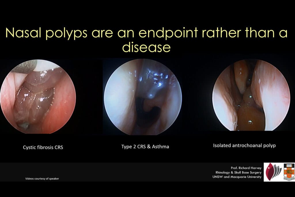 nasal polyps are not the same best ENT sydney