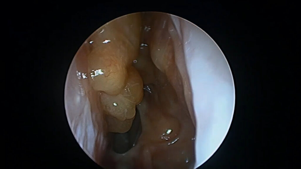 Partial control in nasal polyps