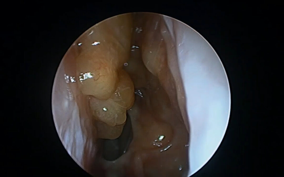 Sinus Surgery and Biologics in CRSwNP: The New Goal Is Remission, Not Just Relief