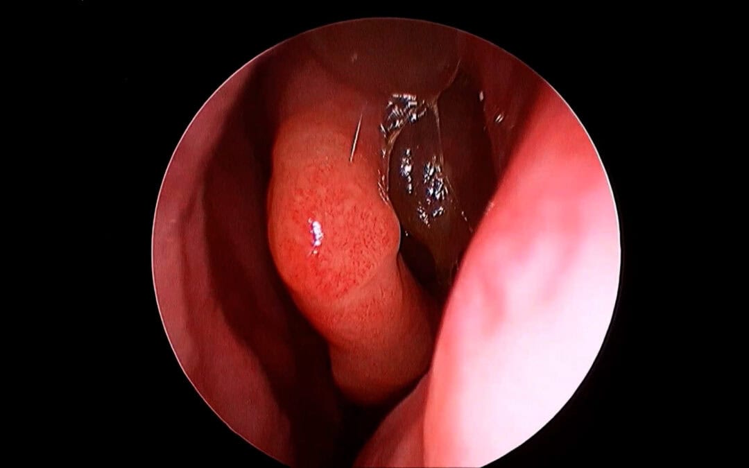 Surgery and Biologics in CRS: Why Combination Therapy Is the Key to Remission