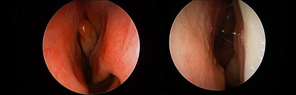 Endoscopic comparison of nasal airway narrowing from turbinate and mucosal changes contributing to nasal obstruction