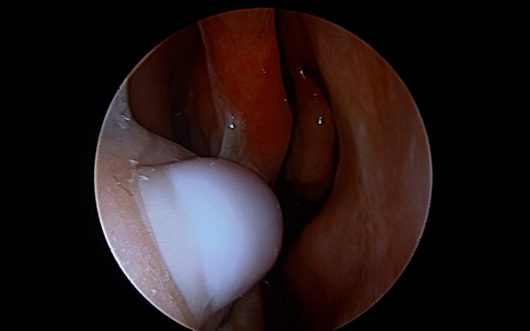 finger in nose picking at perforation