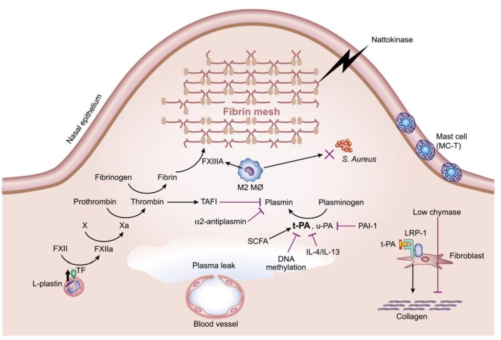 Diagram showing how type 2 inflammation, plasma leakage, fibrin deposition and impaired fibrinolysis contribute to nasal polyp formation.