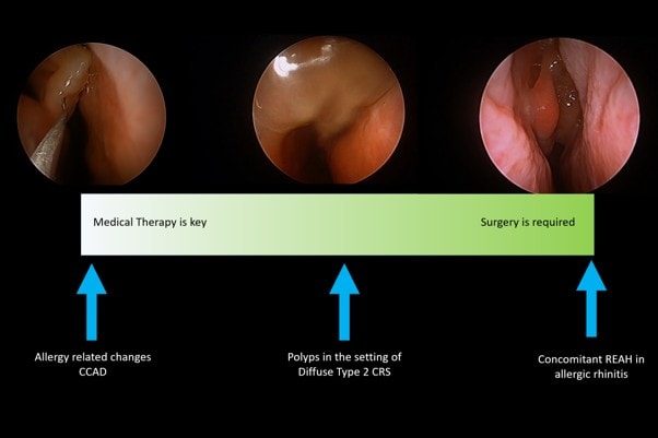 Diagram explaining that treatment for nasal polyps depends on the disease mechanism, ranging from allergy-directed medical therapy to combined surgery and medical treatment.