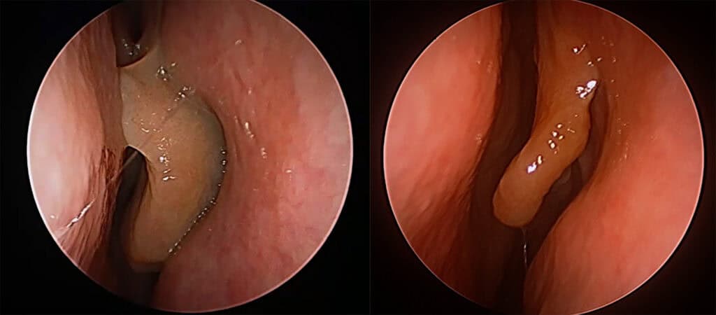 changes to the middel turbinate in allergy