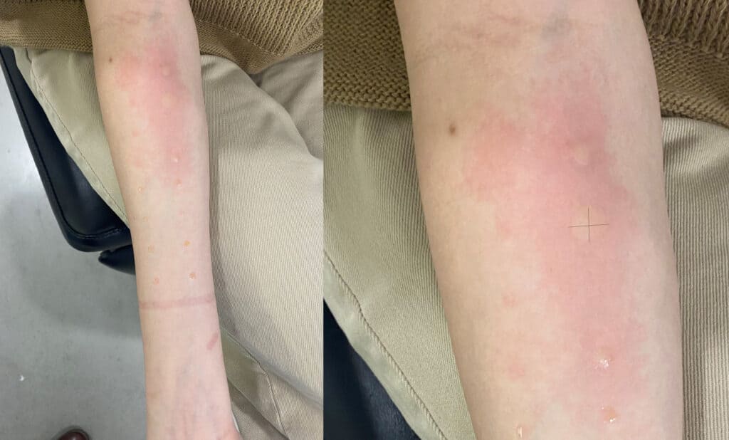 Skin-prick allergy test in a patient with symptoms of allergic rhinitis