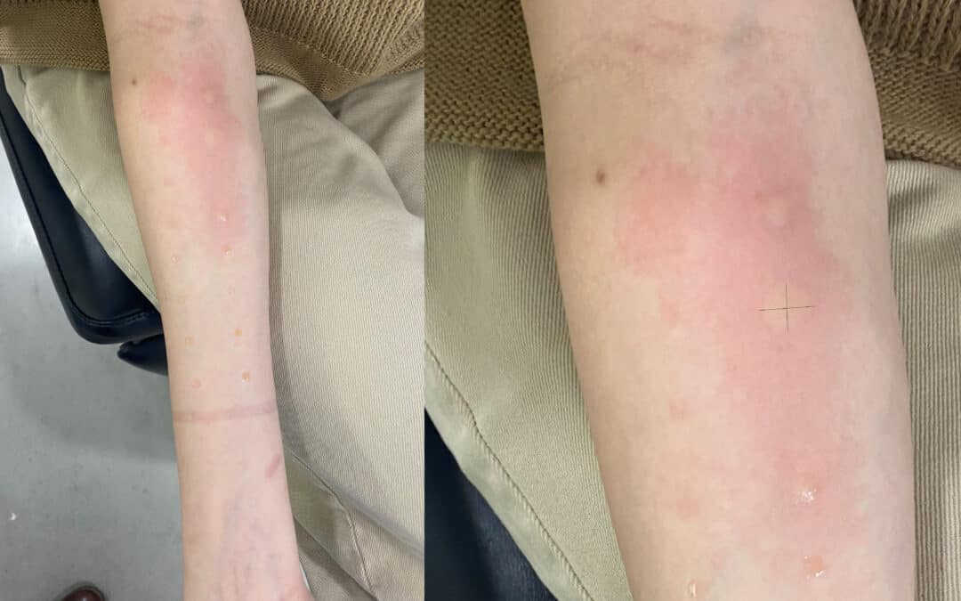 When a Negative Allergy Test Does Not Rule Out Allergy