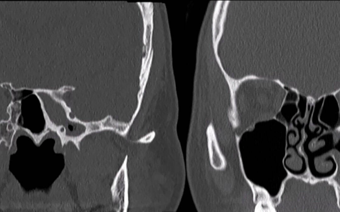 Fungal Ball of the Sinuses: Treat the Failed Sinus, Not Just the Fungus
