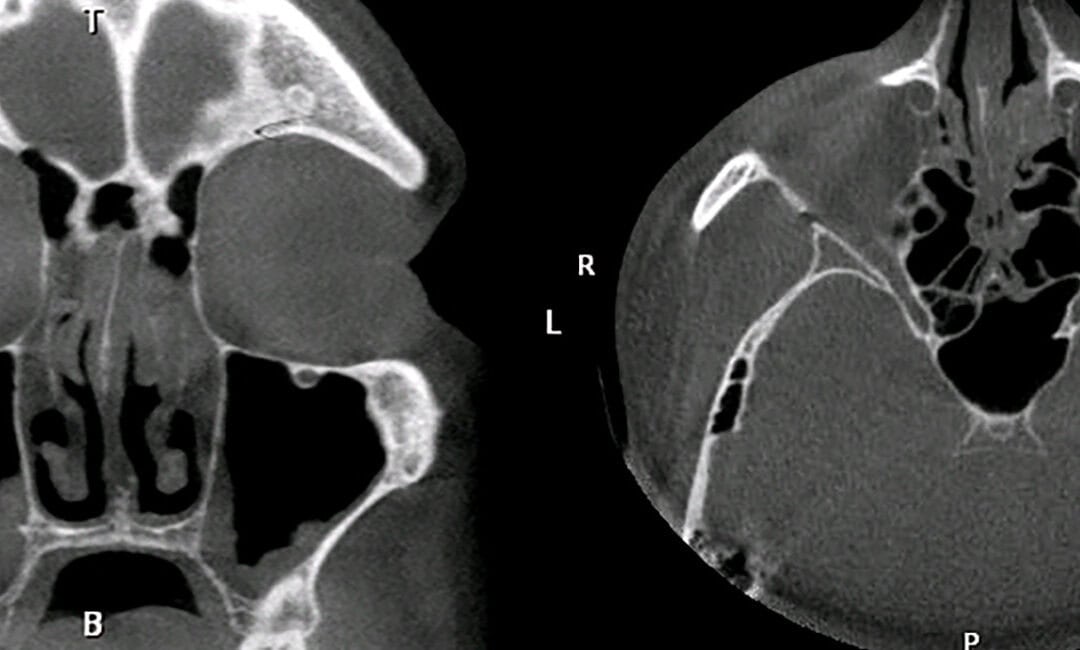 Central Compartment Atopic Disease (CCAD): The Defining Clinical Features