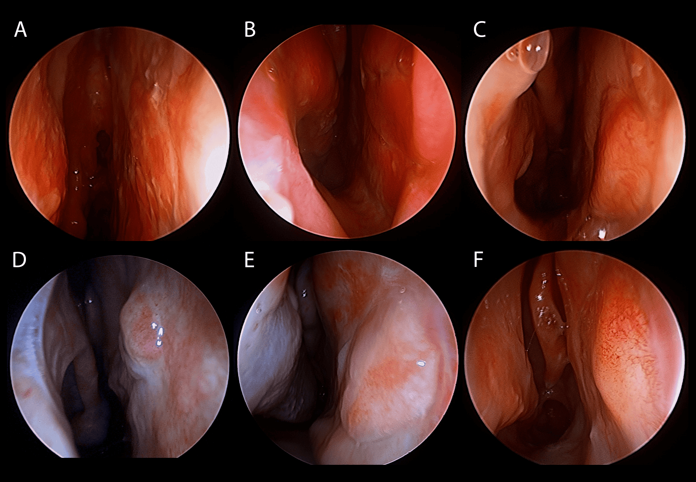 Endoscopic healing after free mucosal grafting during septal perforation repair